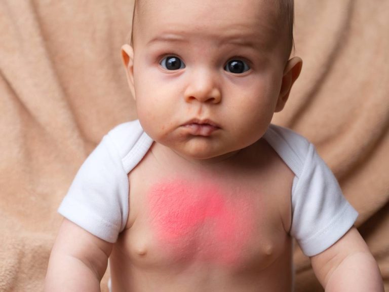 comment gérer les reflux gastriques chez les nourrissons